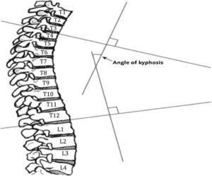 Angle of kyphosis