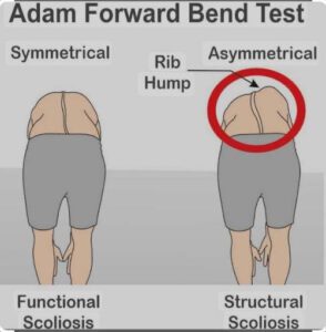 Adam's Test