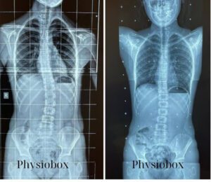 PhysioBox_scroth method