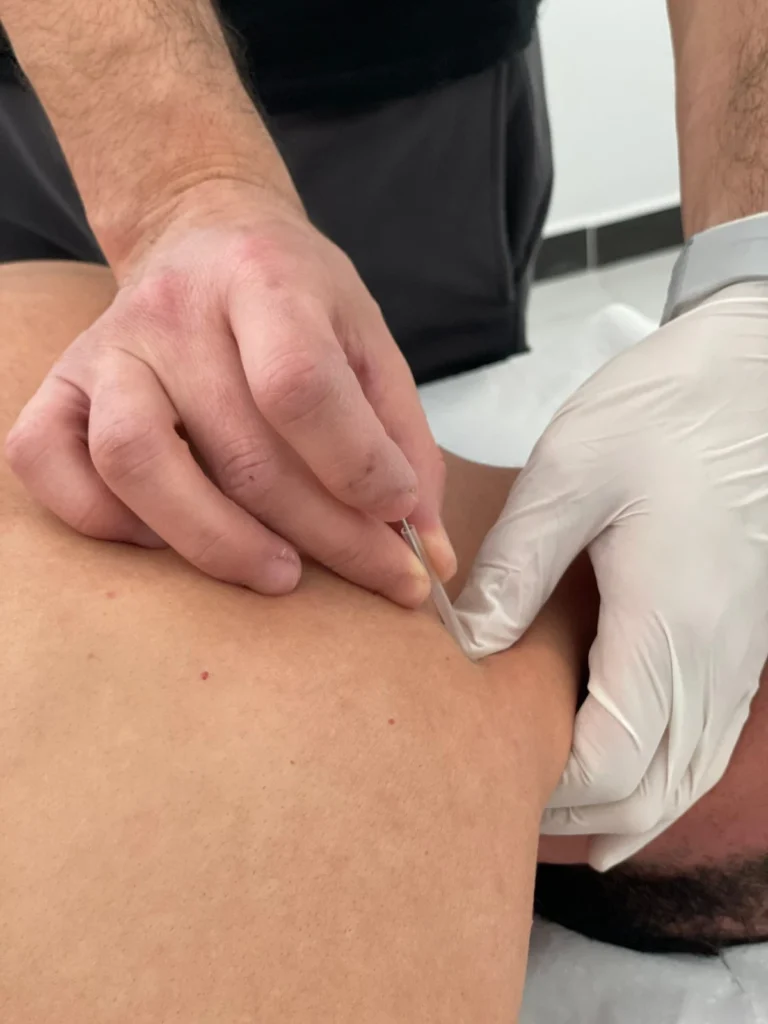 PhysioBox Acupuncture